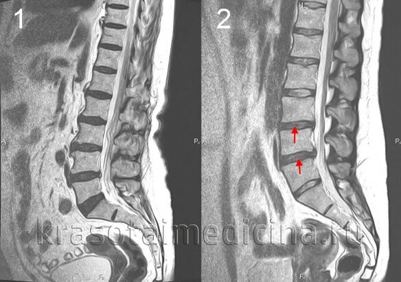 Osteochondros vun der Wirbelsäit