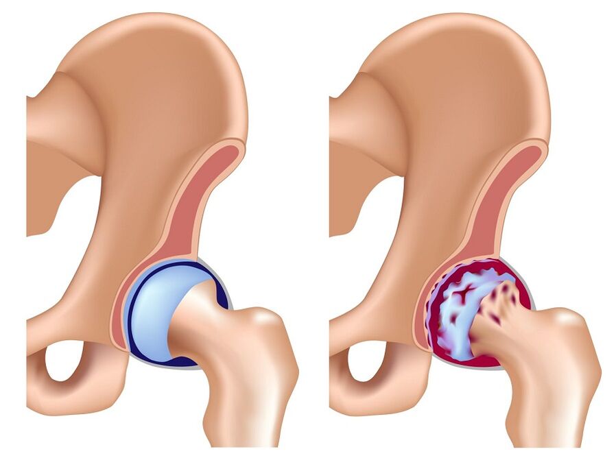 gesond Gelenk an Arthrosis vun der Hip Gelenk